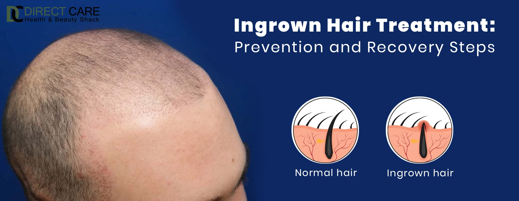 Ingrown Hair Treatment: Prevention and Recovery Steps Personal Care article